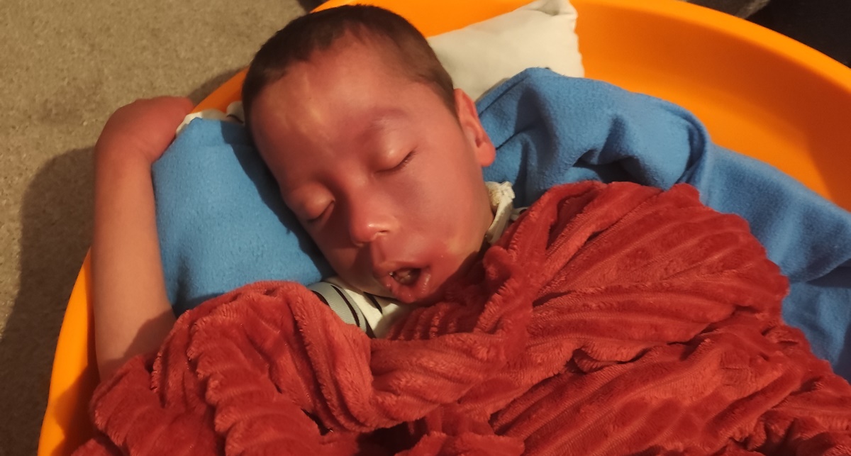 Ábel 3 hónapos korában agyvérzést kapott!