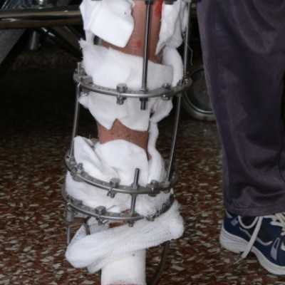 4,7 millió forintos Orthofix rendszer átadása a Semmelweis Egyetem Ortopédiai Klinikájának - adó, 1%, alapítvány, támogatás